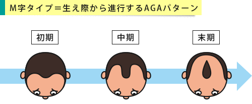 男性型脱毛症の症状 Agaによる薄毛の特徴と進行パターン 薬の通販オンライン